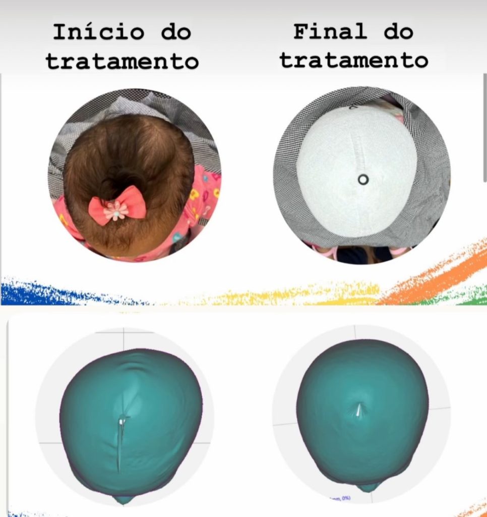Instituto Fábio Soler » ASSIMETRIAS E ÓRTESES CRANIANAS 3D