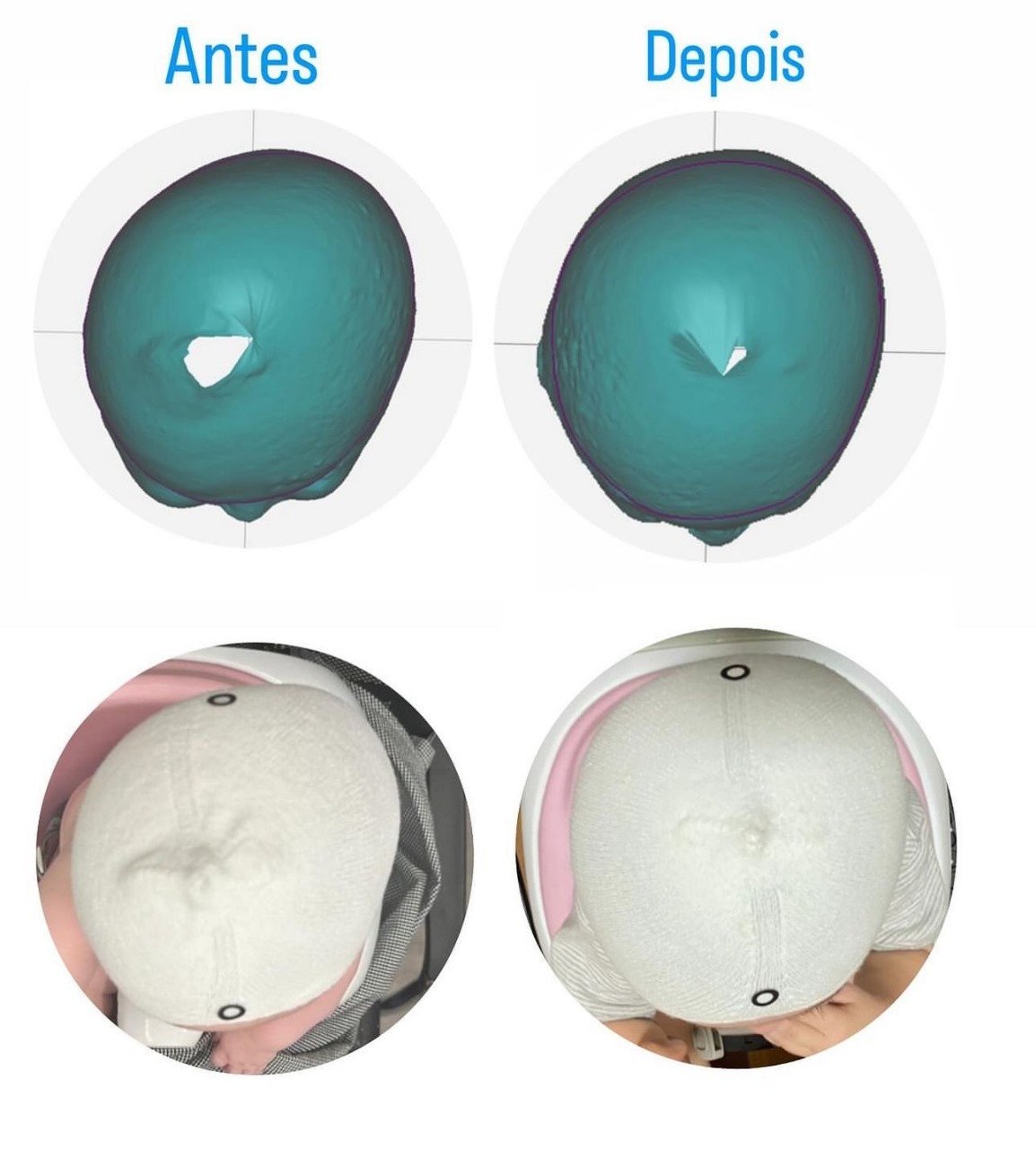 Instituto Fábio Soler » ASSIMETRIAS E ÓRTESES CRANIANAS 3D
